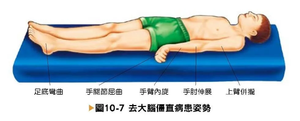 意識變化患者特殊姿態三