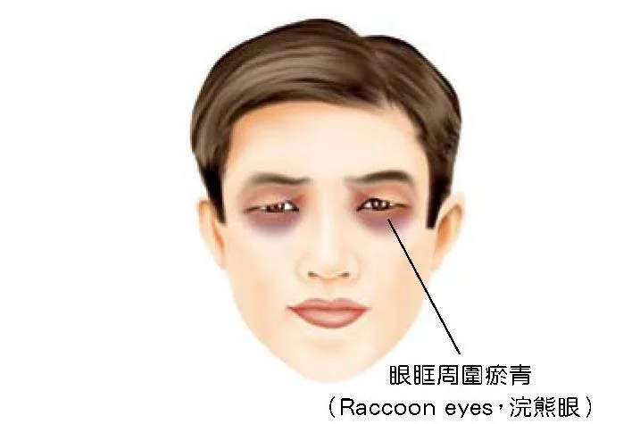 雙側眼眶周圍瘀青，浣熊眼徵候