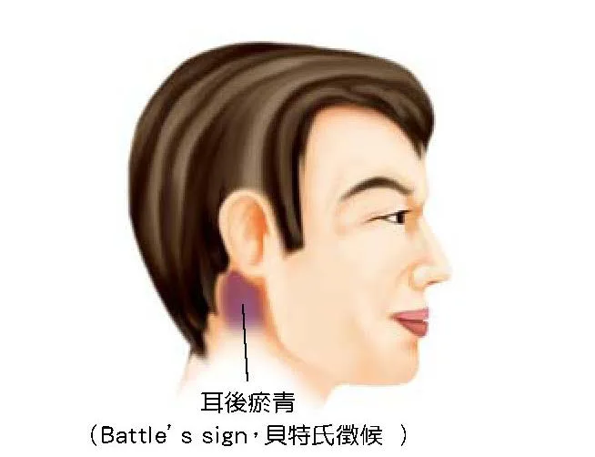 耳後乳突區瘀青，Battle sign