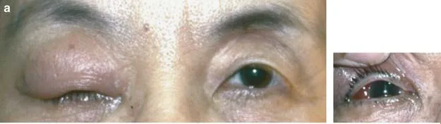 單側非搏動性突眼