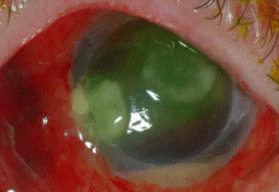 眼內炎