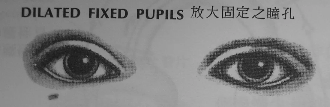 瞳孔光反射檢查