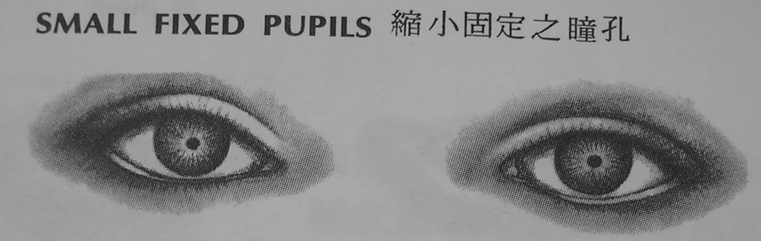 瞳孔大小異常對照