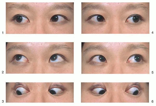 六個方向的眼球運動檢查