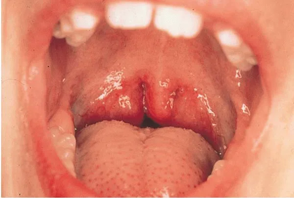 急性扁桃腺炎