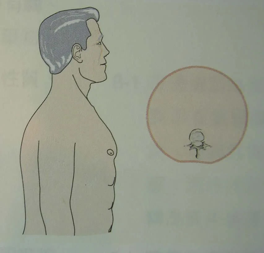 桶狀胸