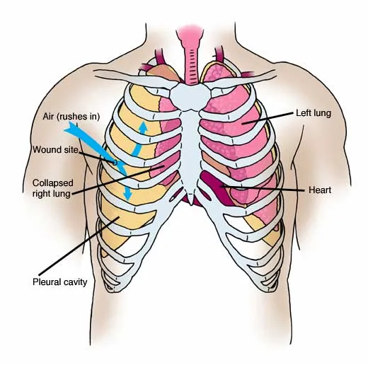 開放性氣胸傷口