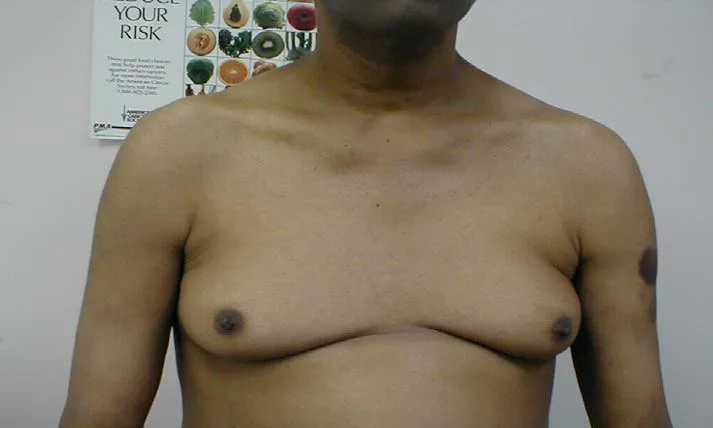 男性女乳症