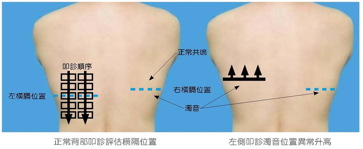 後胸叩診比較兩側橫膈膜位置