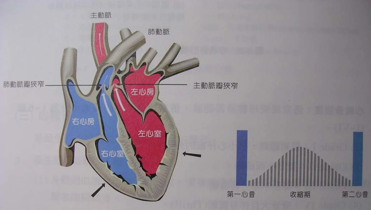收縮期心雜音分類