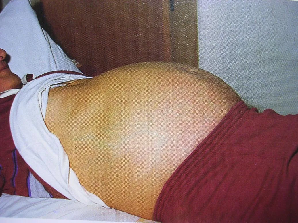 腹水造成的腹部膨隆