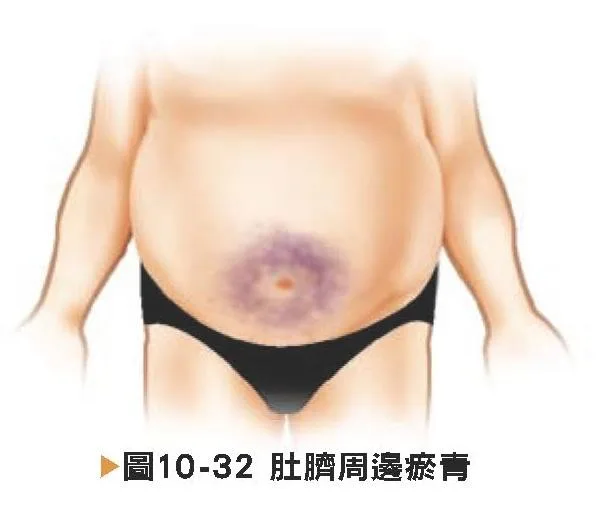臍部周邊瘀青