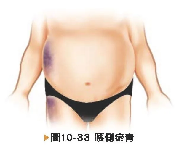 腰側瘀青