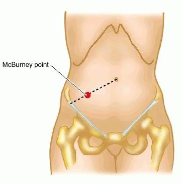 McBurney's point 定位