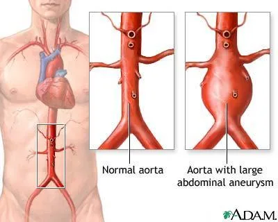 搏動性腹部腫塊