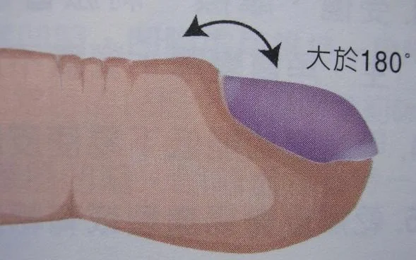 杵狀指的角度變化