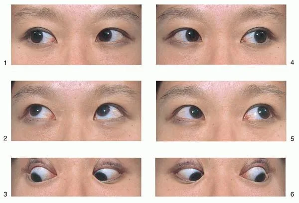 瞳孔光反射檢查