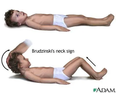 Brudzinski 徵象操作